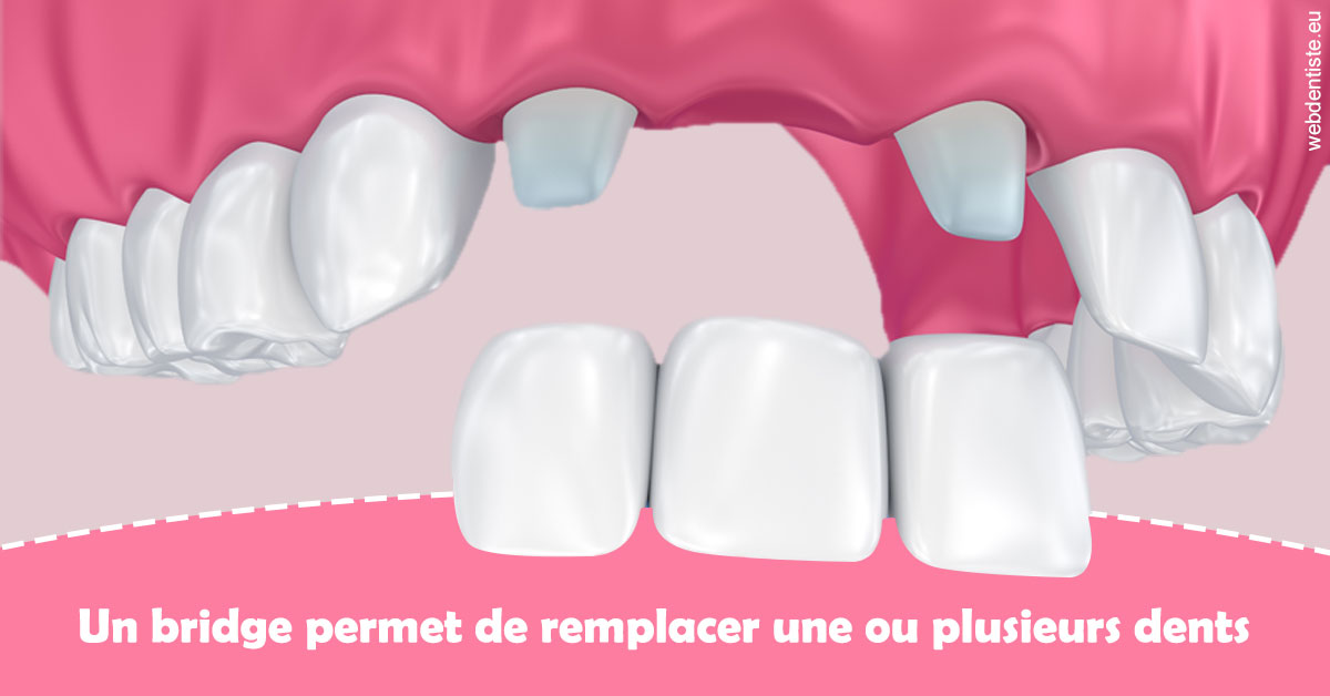 https://www.dr-heitz-dybski.fr/Bridge remplacer dents 2