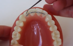 Que faire si le fil de contention se décolle ? | Urgence orthodontie