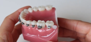 Que faire si le fil orthodontique blesse ? Urgence orthodontie